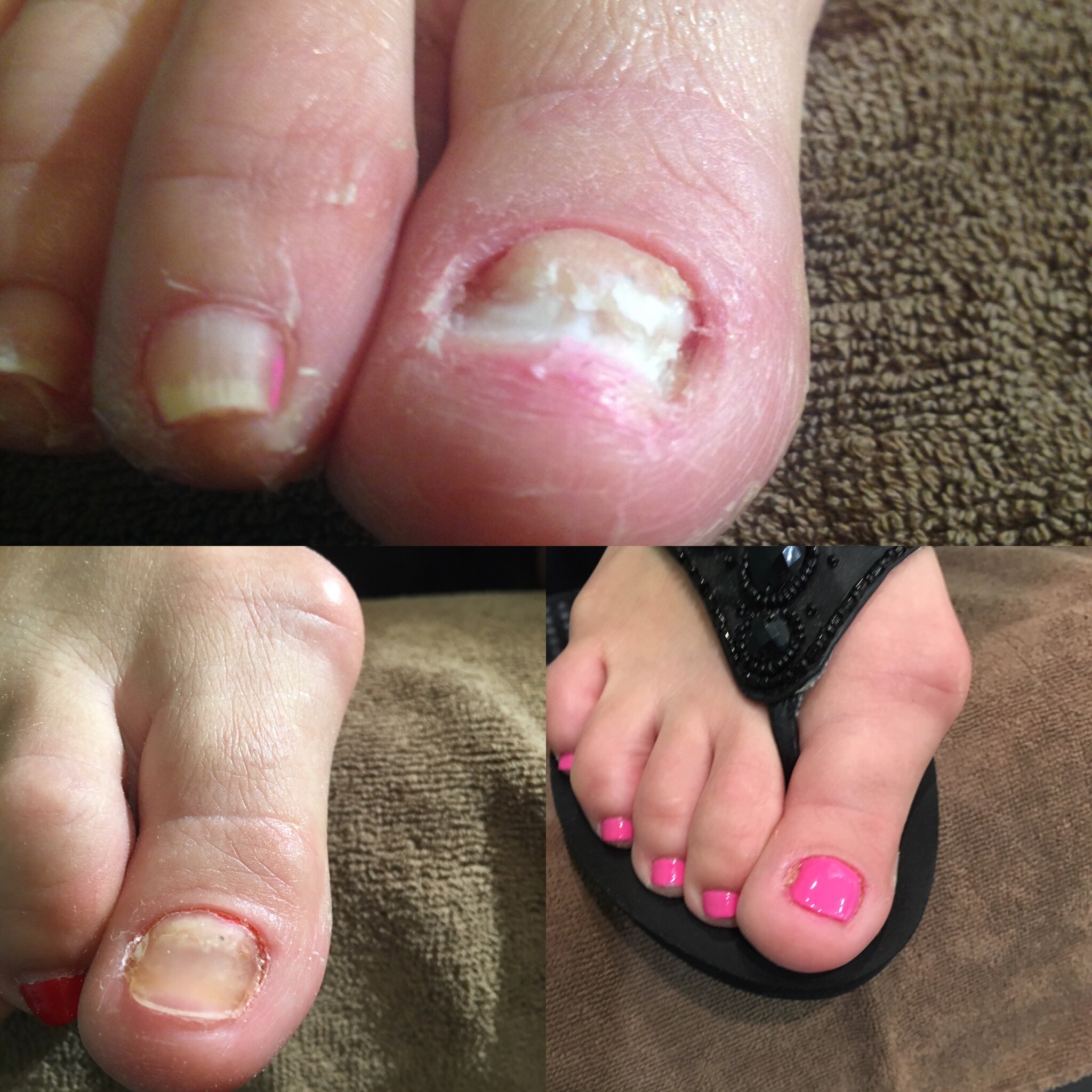 Toenail Reconstruction L'Arte Delle Mani